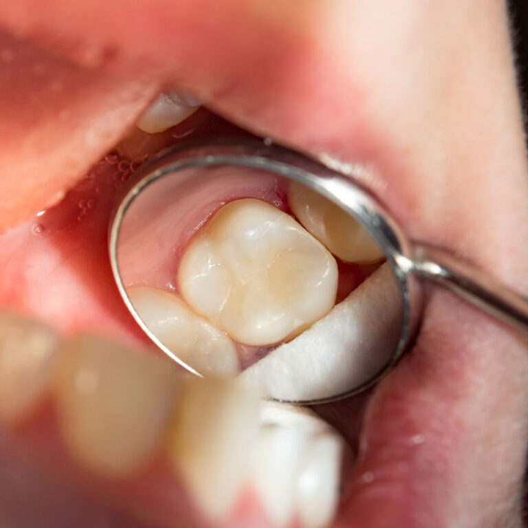 Do white fillings stain over time?