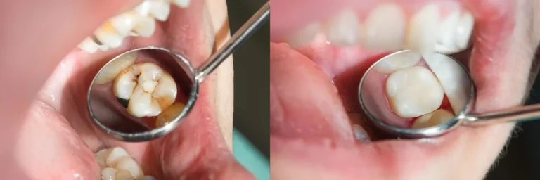white fillings