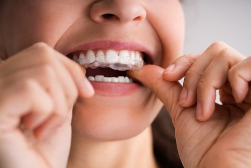 Clear-Aligners-in-Las-Vegas-NV-Invisalign-Free-Consultations