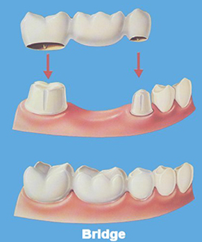 Dental Crowns And Dental Bridges