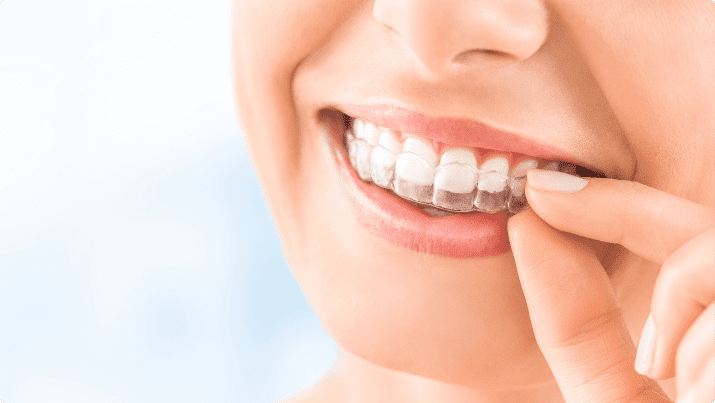Invisalign-Braces-3