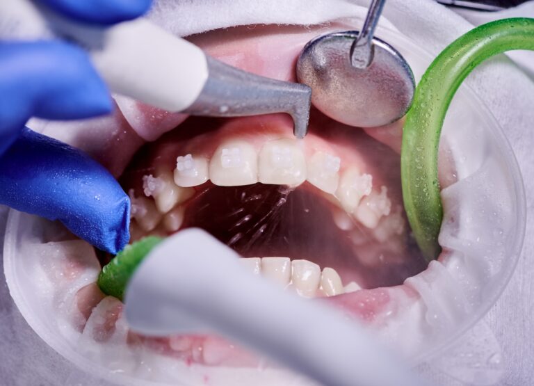 What does a professional teeth cleaning do?